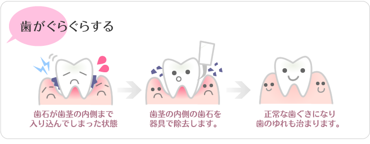 歯がグラグラする（歯石によるゆれ）歯石が歯茎の内側まで入り込んでしまった状態。歯茎の内側の歯石を器具で除去します。正常な歯茎になり歯の揺れもおさまります。