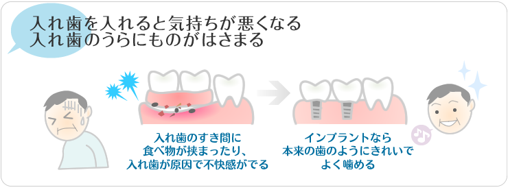 入れ歯を入れrつ尾気持ち悪くなる。入れ歯の裏にものがはさまる。