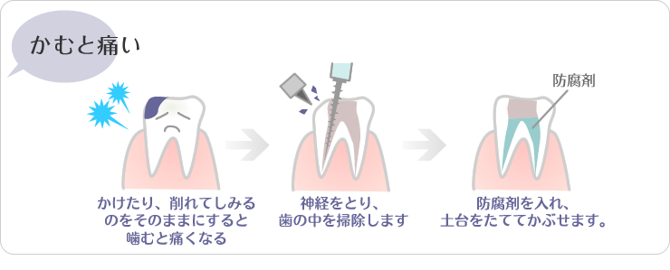 (1)かけたり、削れてしみるのをそのままにすると噛むと痛くなる。(2)神経をとり、歯の中を掃除します（3）防腐剤をいれ、土台をたててかぶせます。