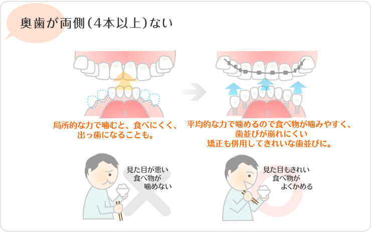 奥歯が両側4本以上ない。局所的な力で噛むと食べにくく、出っ歯になる事も。平均的な力で 噛めるので食べ物が噛みやすくは並びが区連れに食い。矯正も併用してきれいな歯並びに。