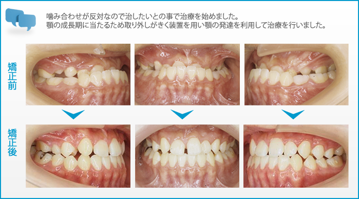 川越市の歯科、本川越歯科の矯正歯科症例写真。噛み合わせが反対なので治したいとの事で治療を始めました。 顎の成長期に当たるため取り外しがきく装置を用い顎の発達を利用して治療を行いました。
