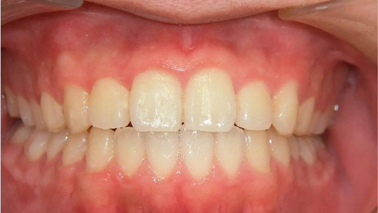 術後・一般歯科医矯正（インビザライン）治療の症例