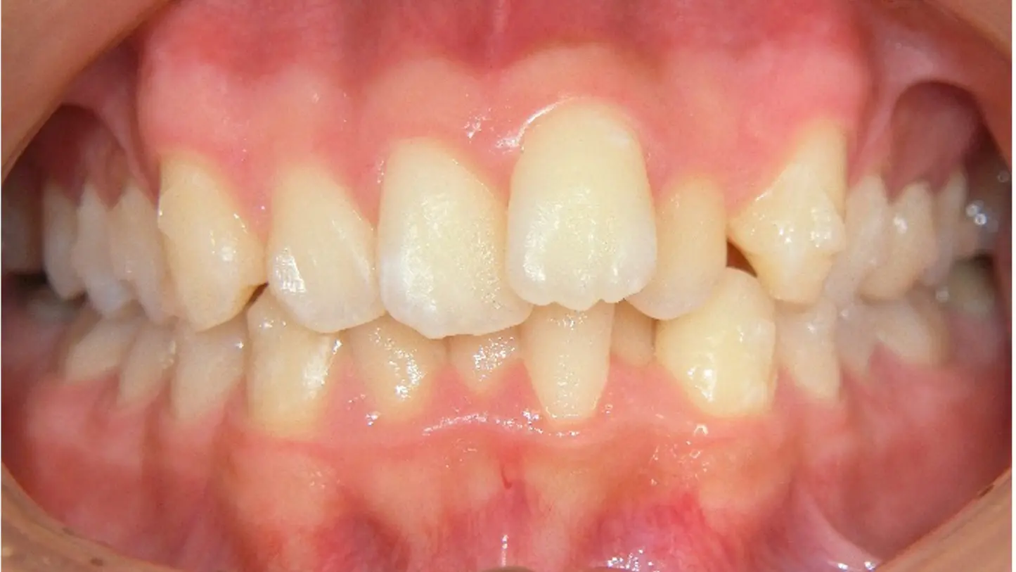 術前・一般歯科医矯正（インビザライン）治療の症例