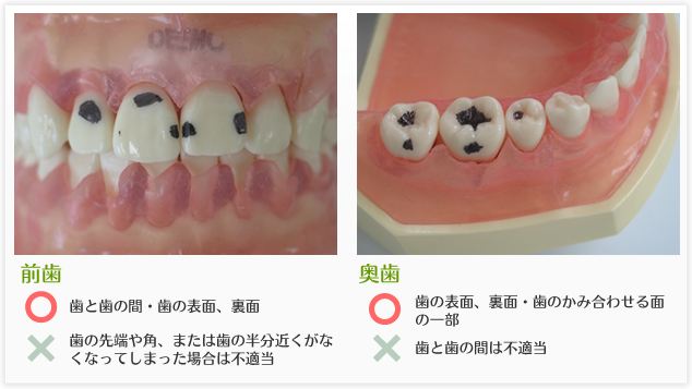 川越の歯科、本川越歯科の保険でできるコンポジットレジン白い樹脂の詰め物