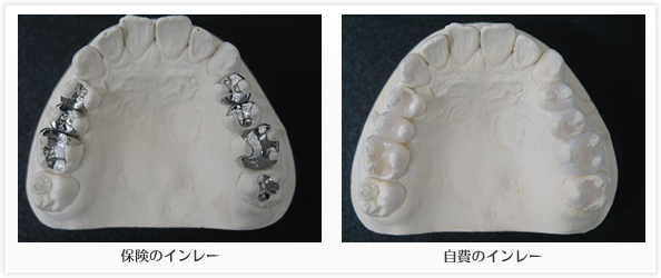 川越の歯科、本川越歯科の保険診療の銀歯のインレーと自費診療の白いインレーの比較
